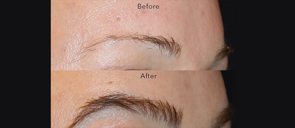 eyebrow-transplant-before-after-image