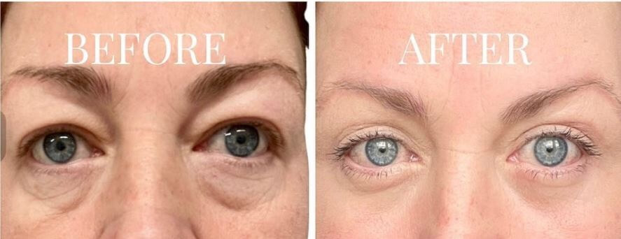eyelid-surgery-before-after