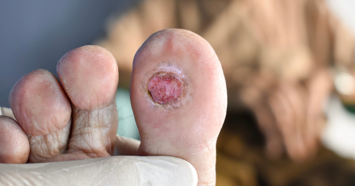 diabetic-foot-treatment