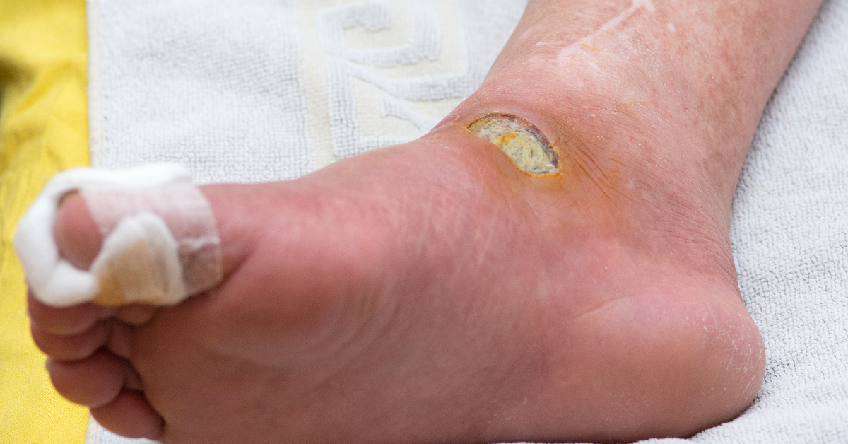 diabetic-foot-treatment-procedure