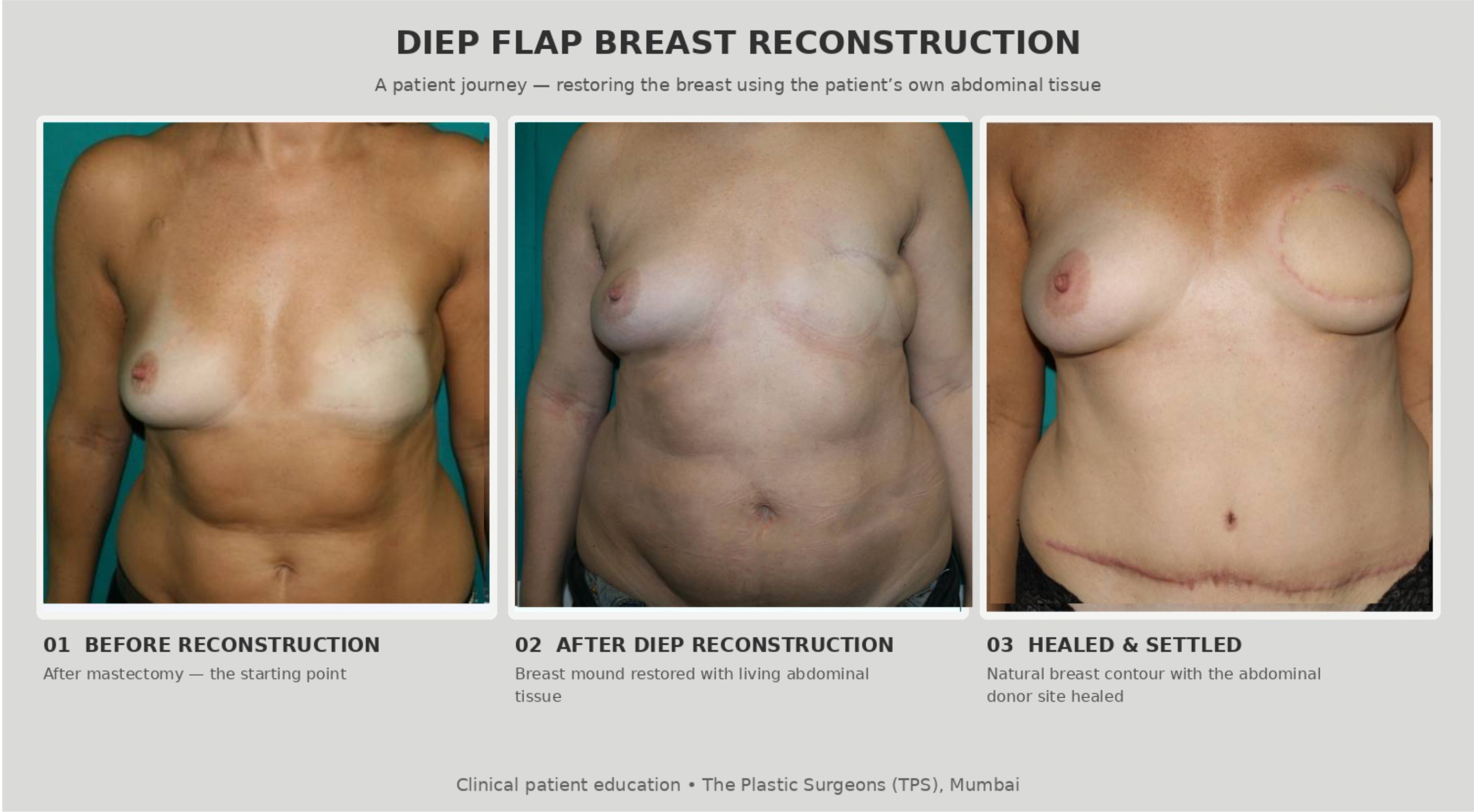 Otoplasty before and after result, posterior view