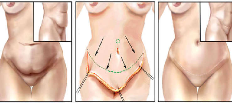 hair-transplant-before-after-image