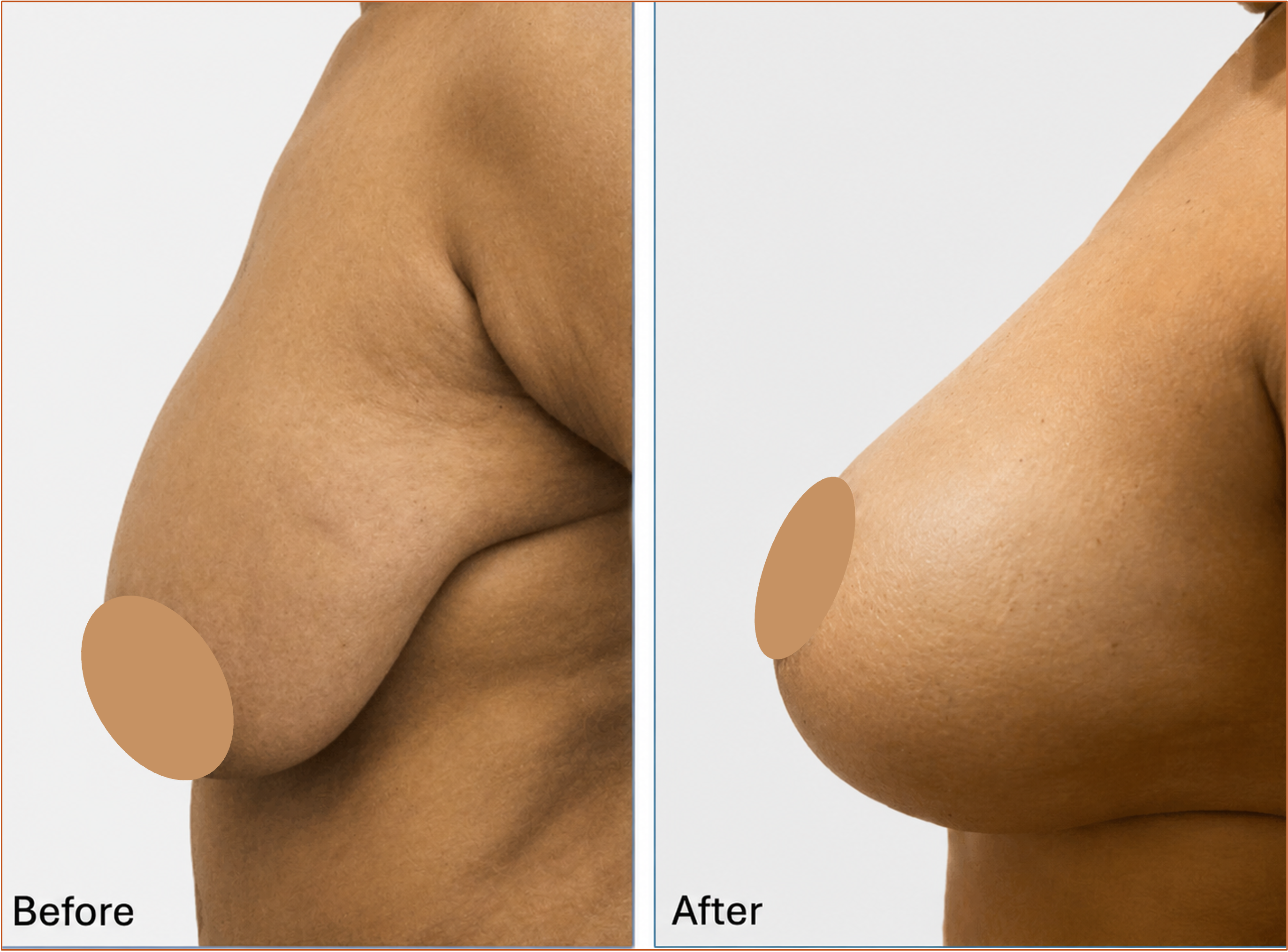 Breast lift before and after result