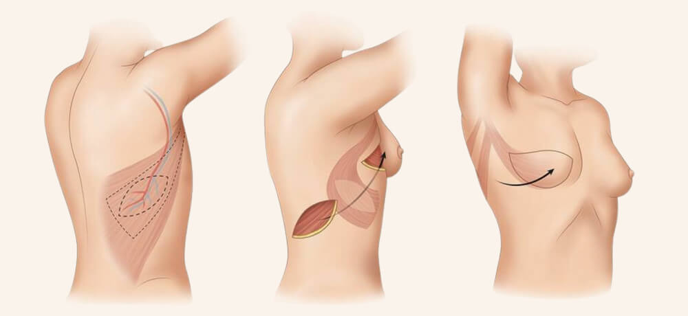 breast-reconstruction