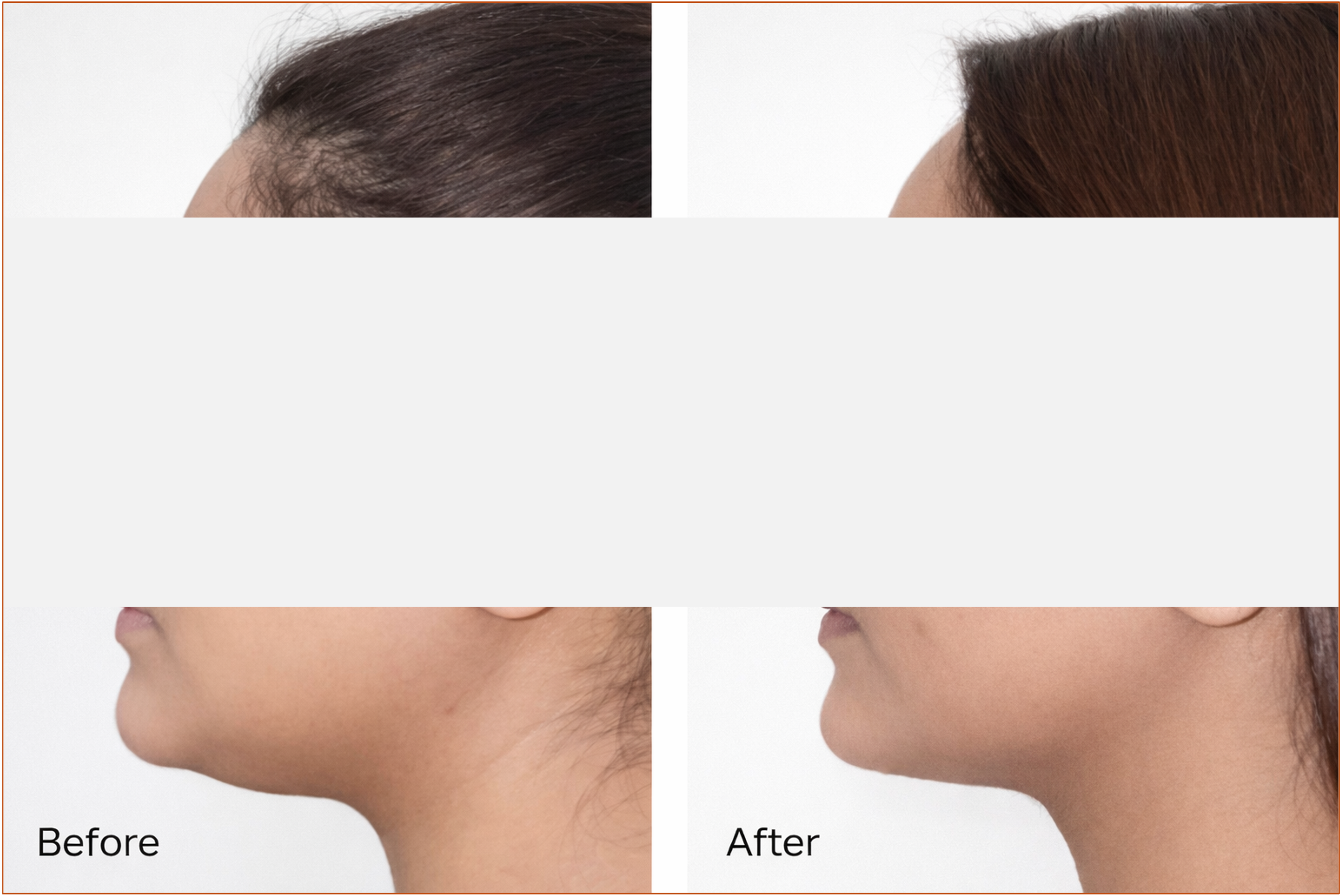 Masked chin liposuction follow-up result