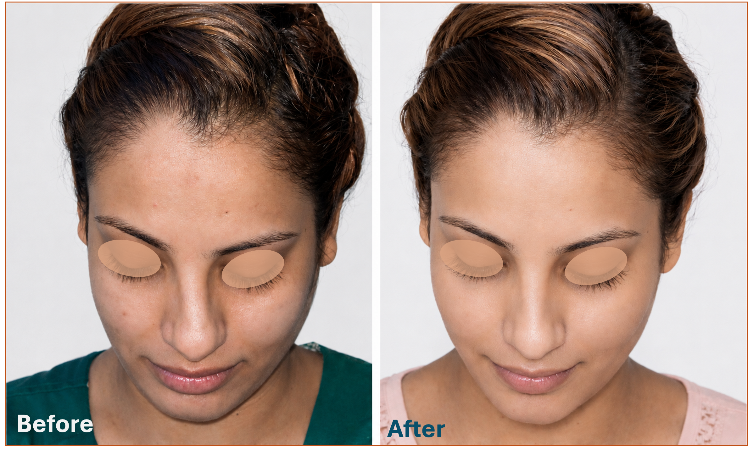 Deviated dorsum correction before and after result