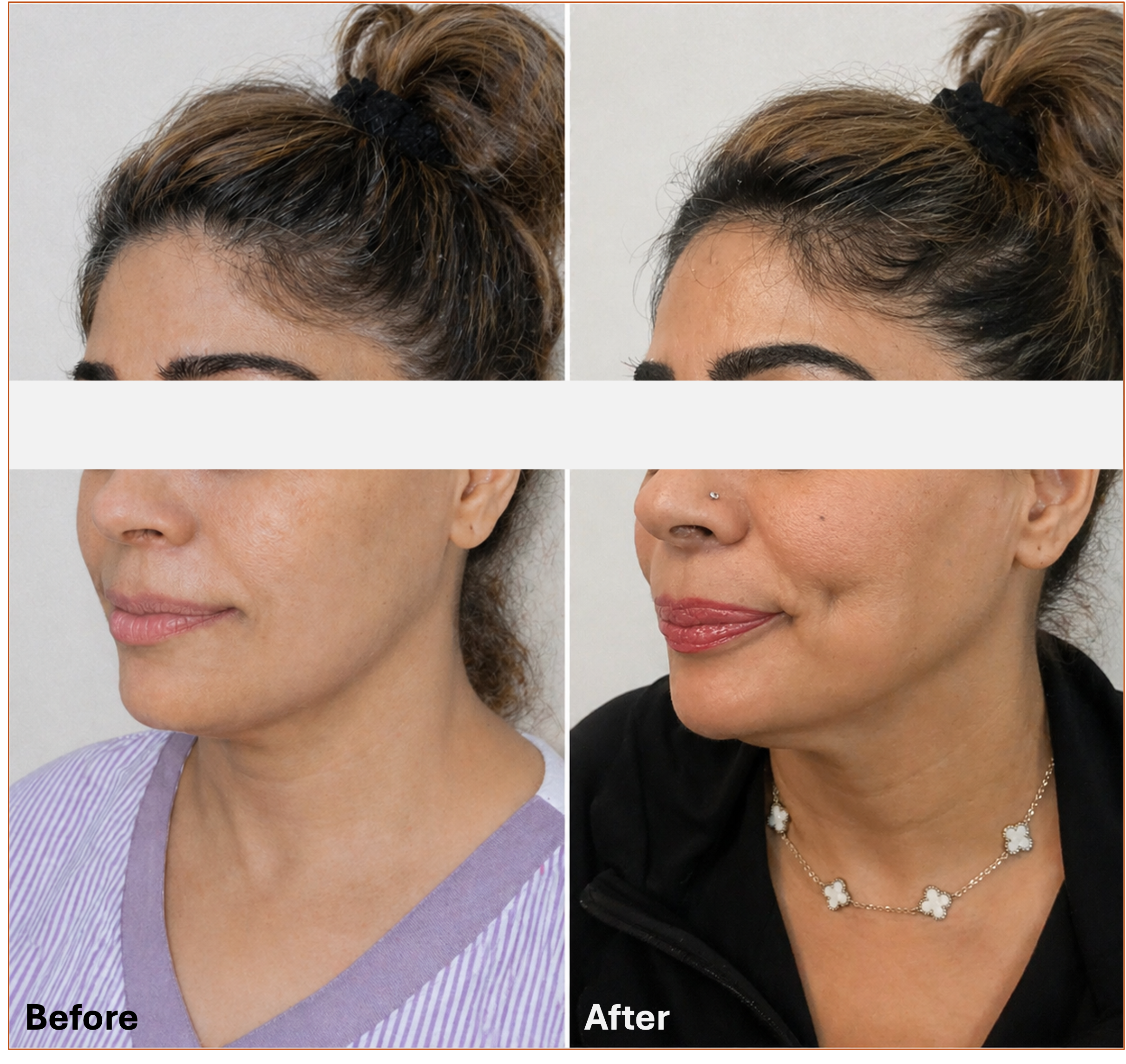 Masked dimple creation before and after result