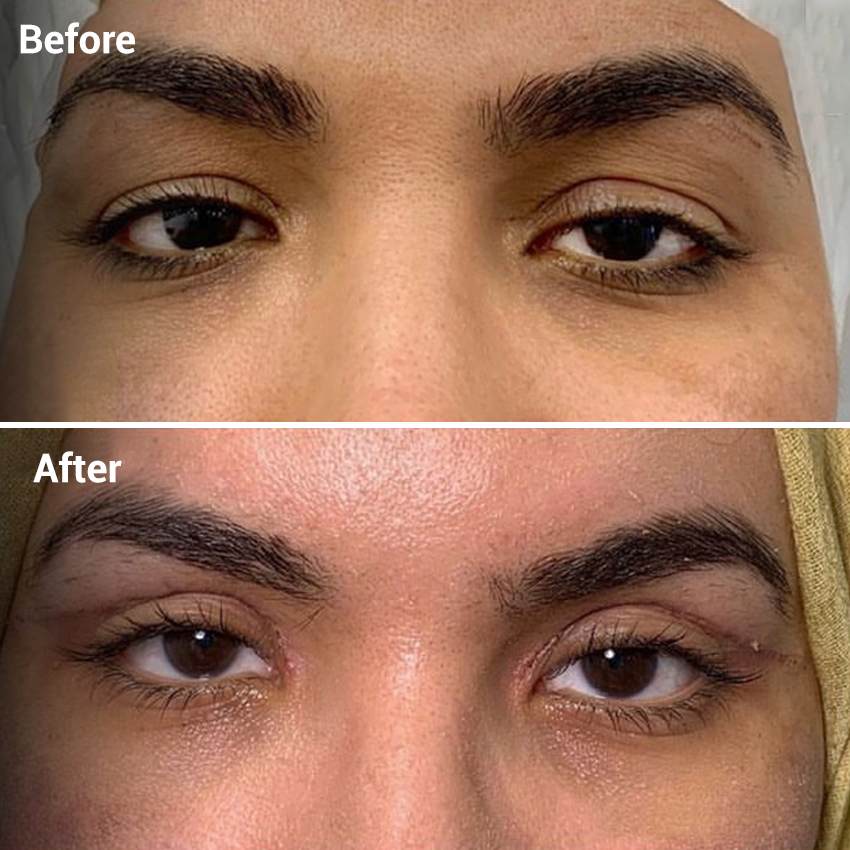 hair-transplant-before-after-image