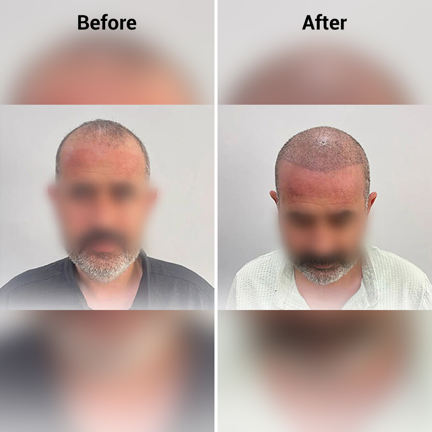 hair-transplant-before-after-image