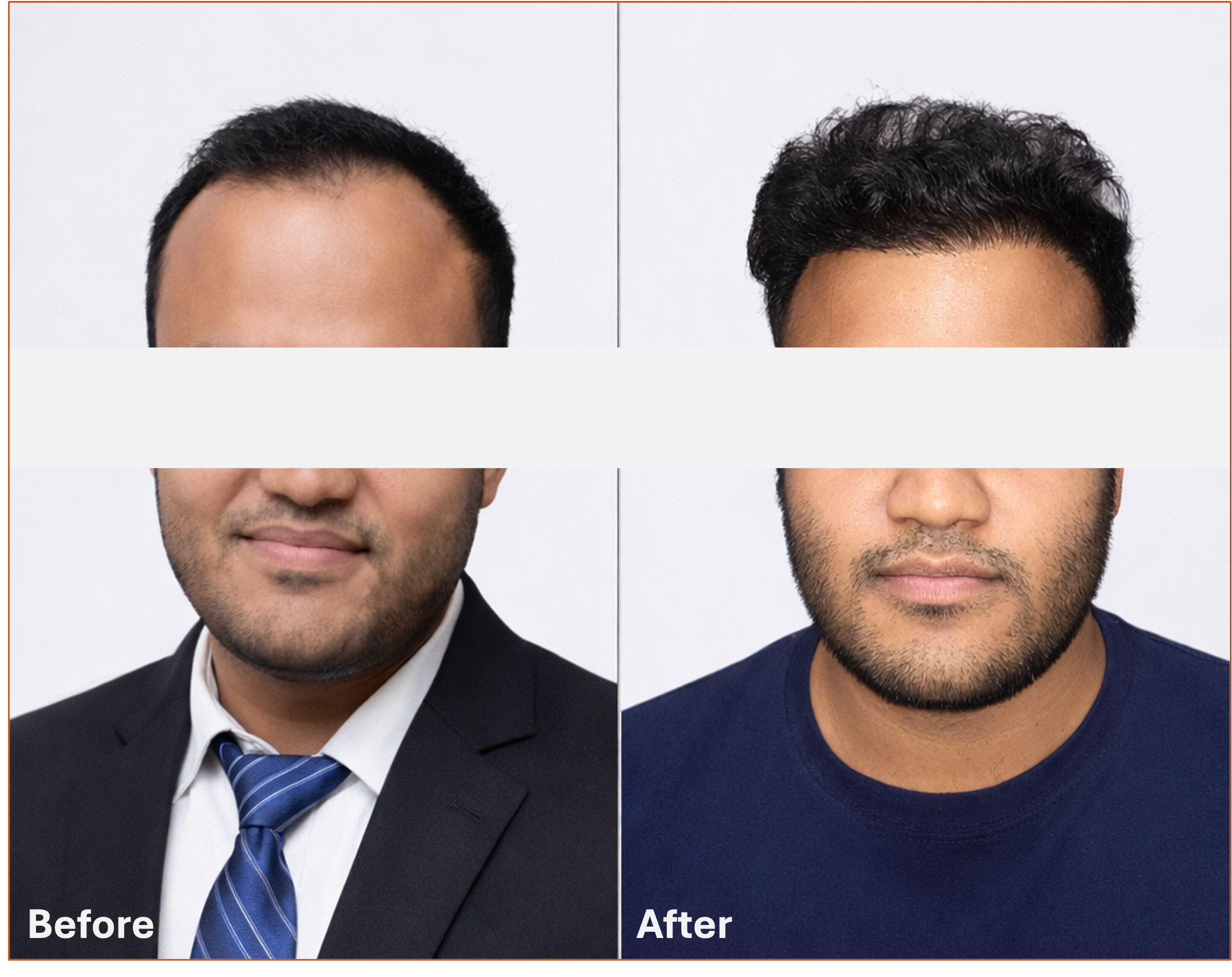 Hair transplant before and after result