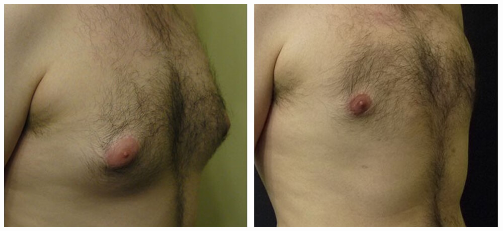 No Visible Scars - Best inverted nipple Surgeon in Mumbai