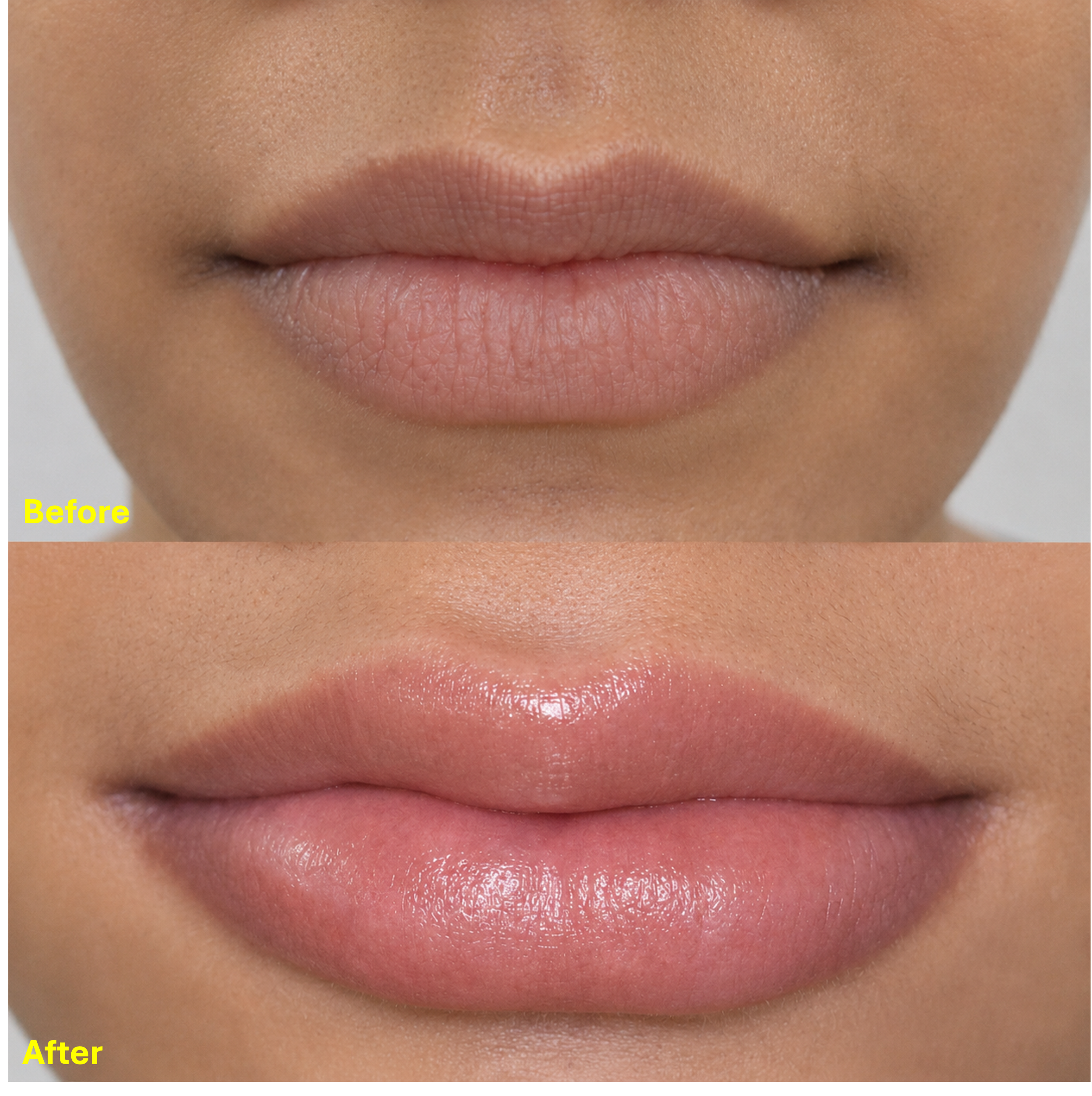 Micro fat lip augmentation before and after result