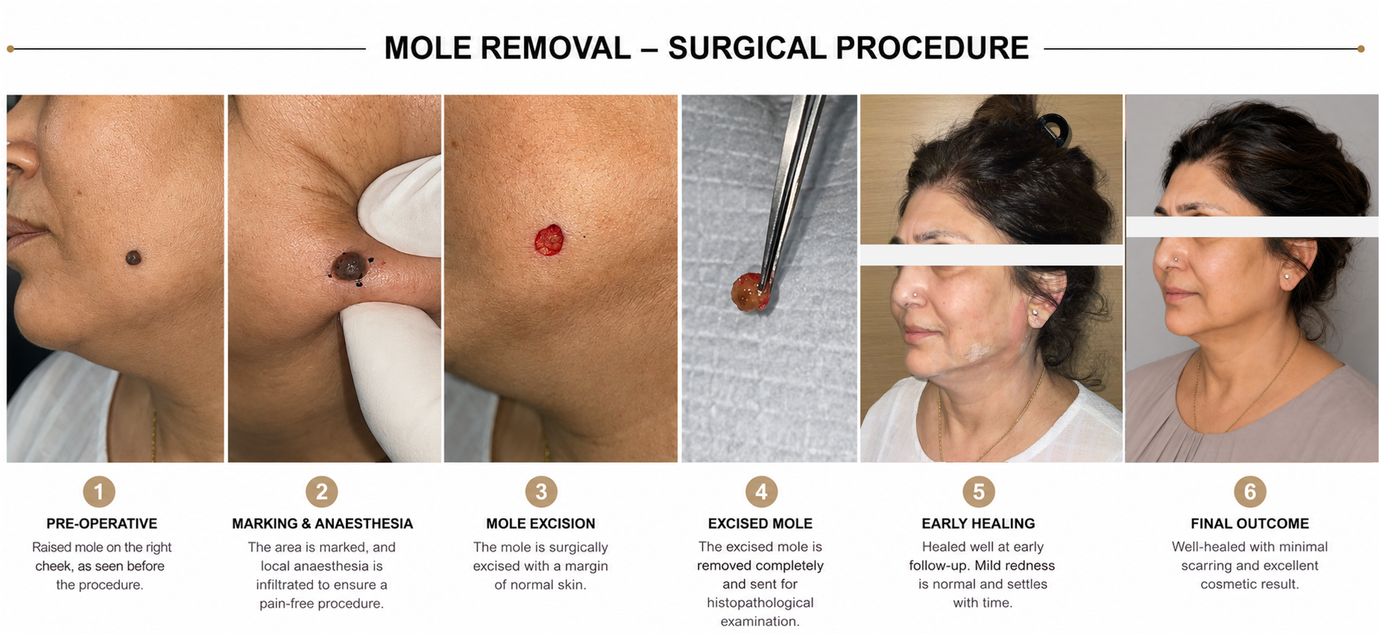 Masked sequence showing mole removal results