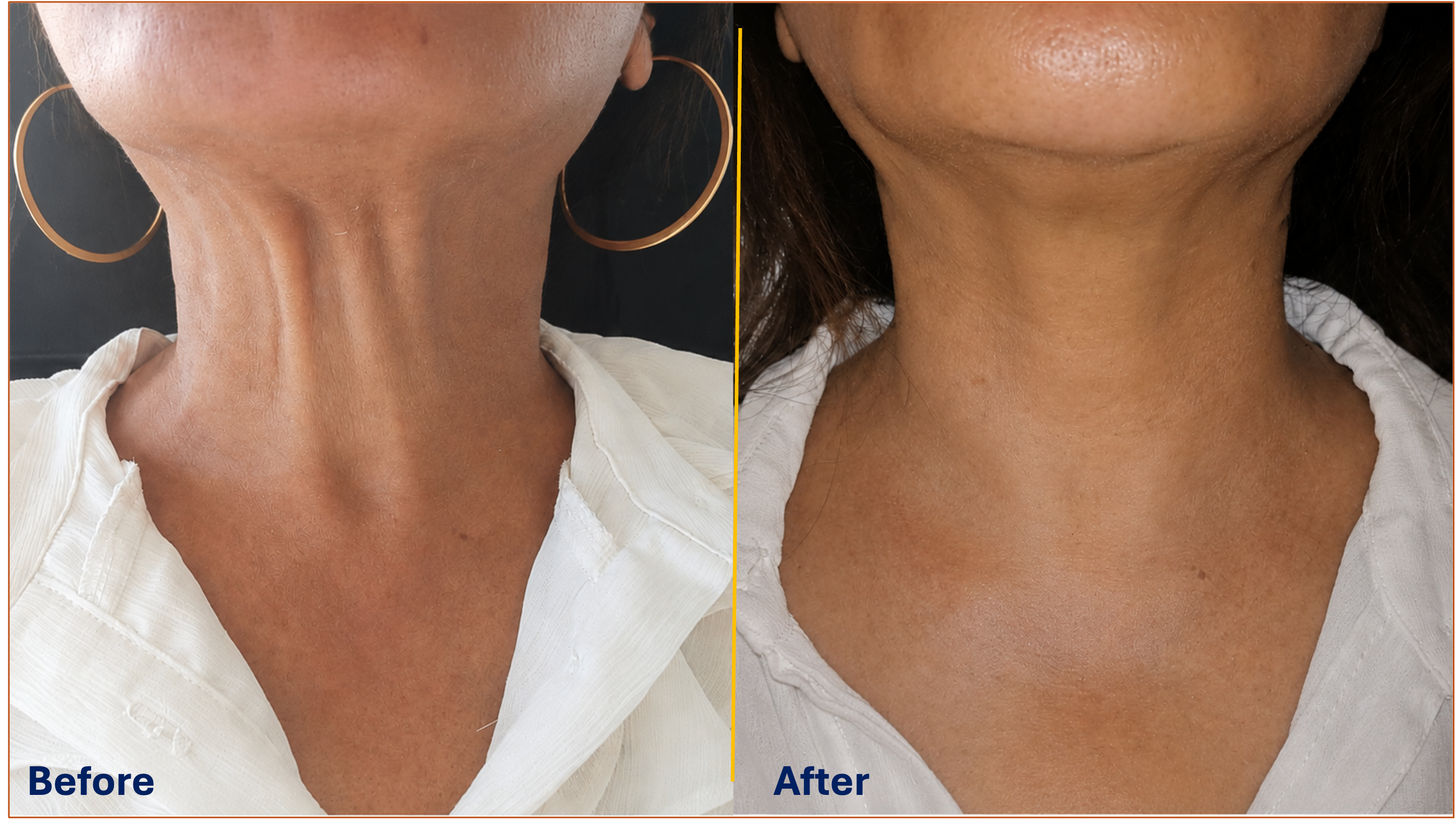 Neck Botox treatment for platysma bands before and after result