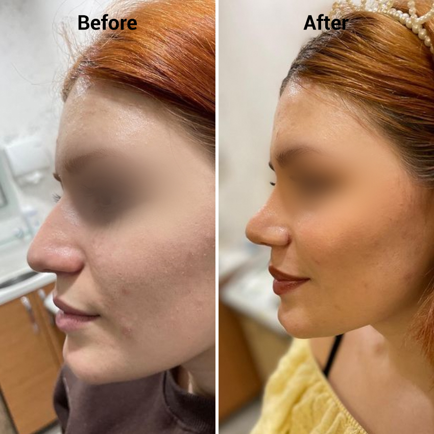 nose-Before-After