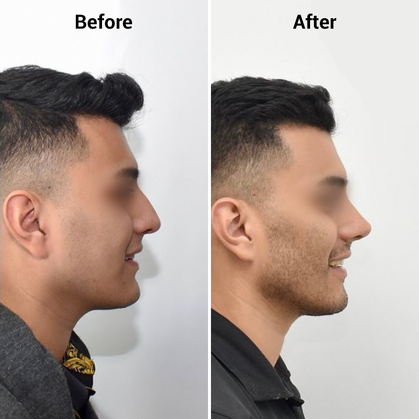 nose-Before-After