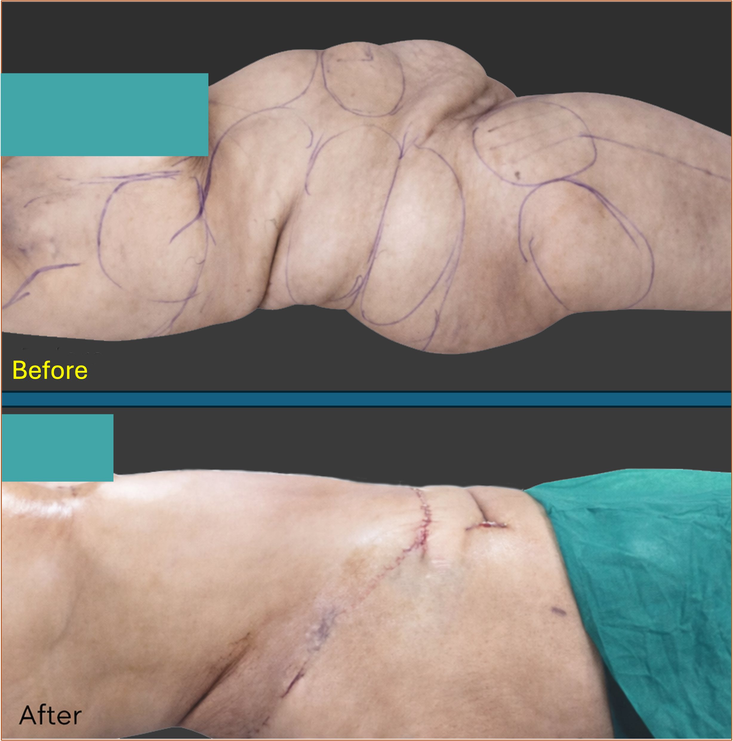 Tummy tuck before and after result