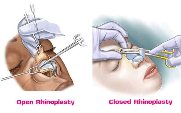 types-rhinoplasty-surgery